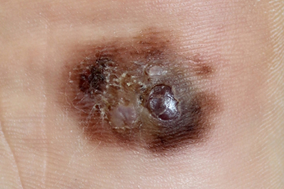 Melanoma of plantar foot surface