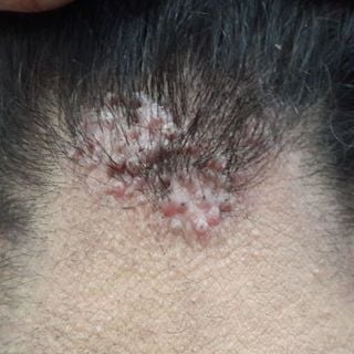 Acne Keloidalis Nuchae