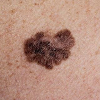 Melanoma