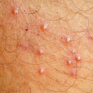 Folliculitis