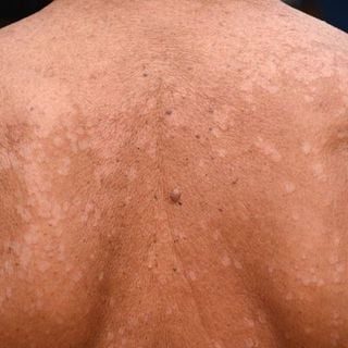 Tinea Versicolor