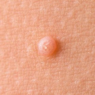 Molluscum Contagiosum