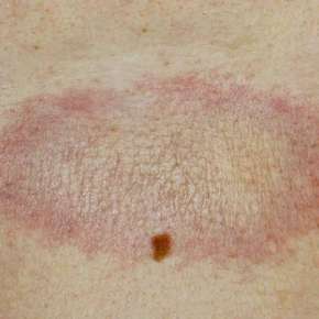 Morphea (Localized Scleroderma)