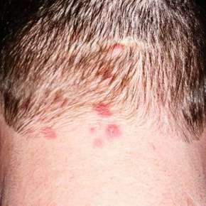 Dermatitis Herpetiformis