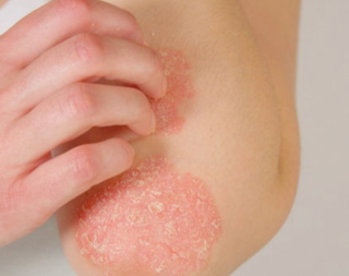 Psoriasis