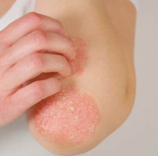 Psoriasis