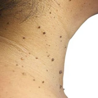 Skin Tags