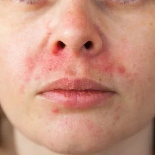 Perioral Dermatitis