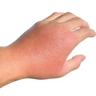 Cellulitis