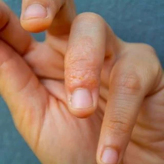 Dyshidrotic Eczema