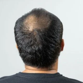 Male Pattern Hair Loss (Androgenetic Alopecia)