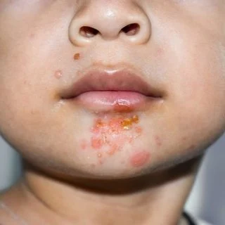 Impetigo