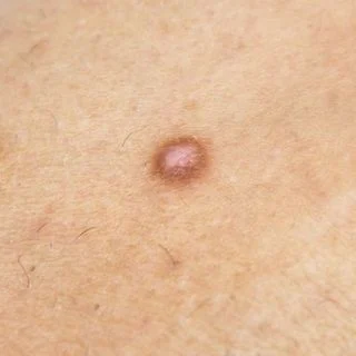 Dermatofibroma