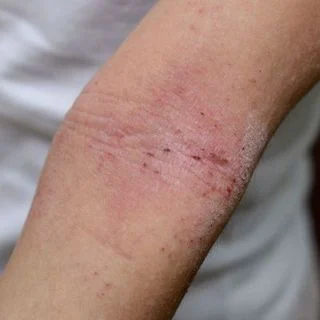 Atopic Dermatitis